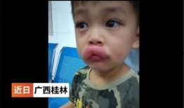 吃瓜嘴巴肿了,嘴巴肿成“香瓜”的尴尬经历